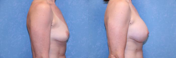 Before & After Breast Augmentation Case 568 Right Side View in Toledo, Ohio