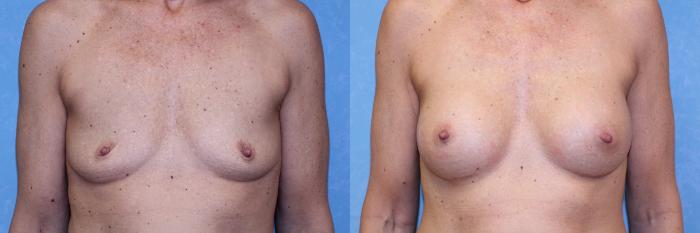 Before & After Breast Augmentation Case 574 Front View in Toledo, Ohio