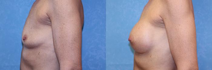 Before & After Breast Augmentation Case 574 Left Side View in Toledo, Ohio