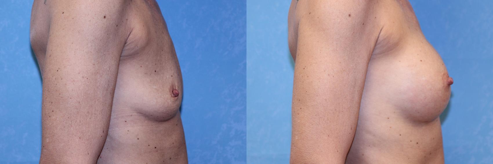 Before & After Breast Augmentation Case 574 Right Side View in Toledo, Ohio