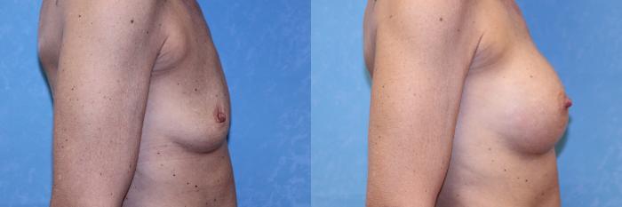 Before & After Breast Augmentation Case 574 Right Side View in Toledo, Ohio