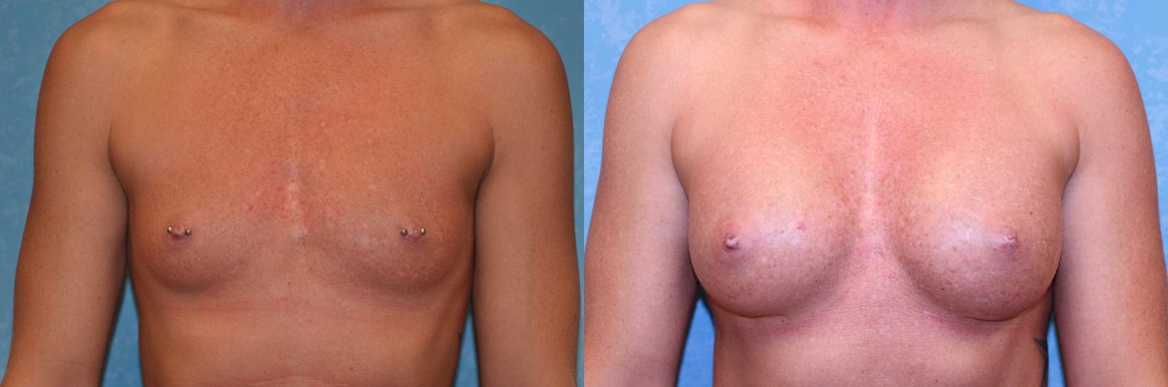 Before & After Breast Augmentation Case 582 Front View in Toledo, Ohio