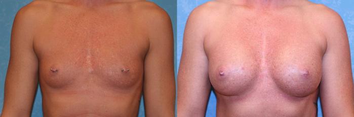 Before & After Breast Augmentation Case 582 Front View in Toledo, Ohio