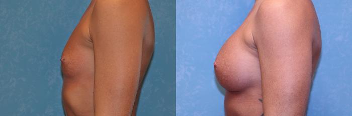 Before & After Breast Augmentation Case 582 Left Side View in Toledo, Ohio