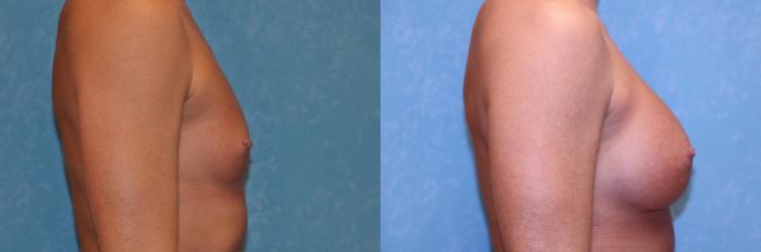 Before & After Breast Augmentation Case 582 Right Side View in Toledo, Ohio