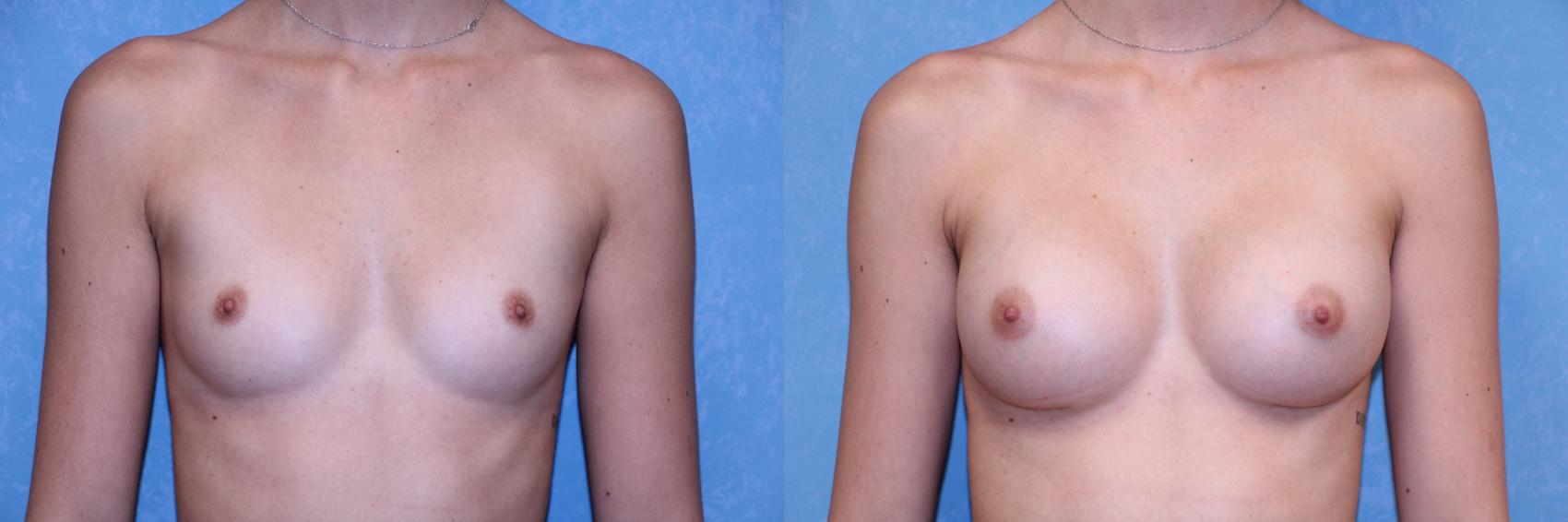 Before & After Breast Augmentation Case 590 Front View in Toledo, Ohio