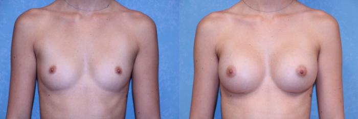 Before & After Breast Augmentation Case 590 Front View in Toledo, Ohio