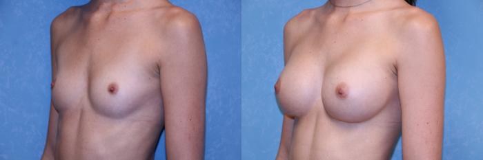 Before & After Breast Augmentation Case 590 Left Oblique View in Toledo, Ohio