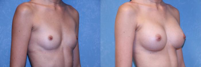 Before & After Breast Augmentation Case 590 Right Oblique View in Toledo, Ohio