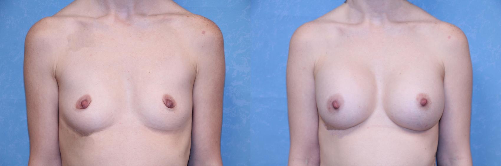 Before & After Breast Augmentation Case 591 Front View in Toledo, Ohio
