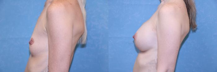 Before & After Breast Augmentation Case 591 Left Side View in Toledo, Ohio
