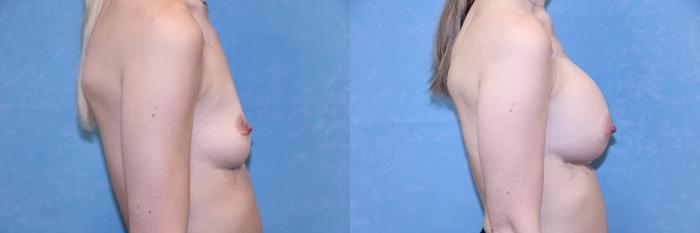 Before & After Breast Augmentation Case 591 Right Side View in Toledo, Ohio