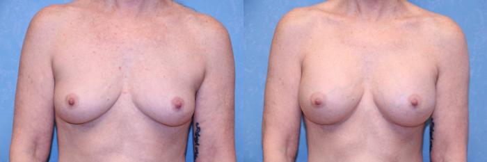 Before & After Breast Augmentation Case 592 Front View in Toledo, Ohio