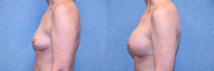 Before & After Breast Augmentation Case 592 Left Side View in Toledo, Ohio