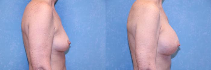 Before & After Breast Augmentation Case 592 Right Side View in Toledo, Ohio