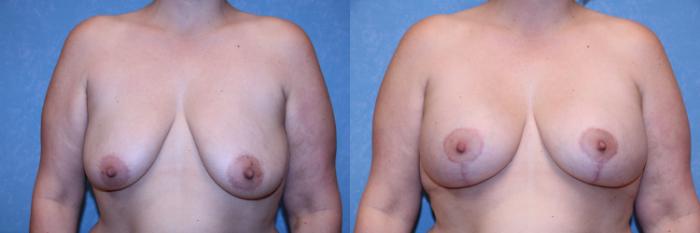 Before & After Breast Augmentation Case 608 Front View in Toledo, Ohio
