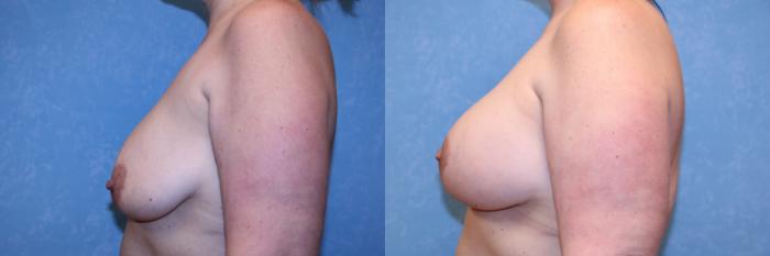 Before & After Breast Augmentation Case 608 Left Side View in Toledo, Ohio