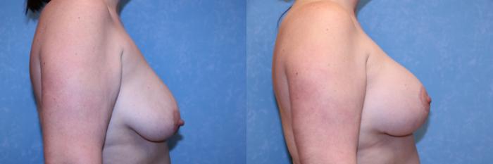 Before & After Breast Augmentation Case 608 Right Side View in Toledo, Ohio
