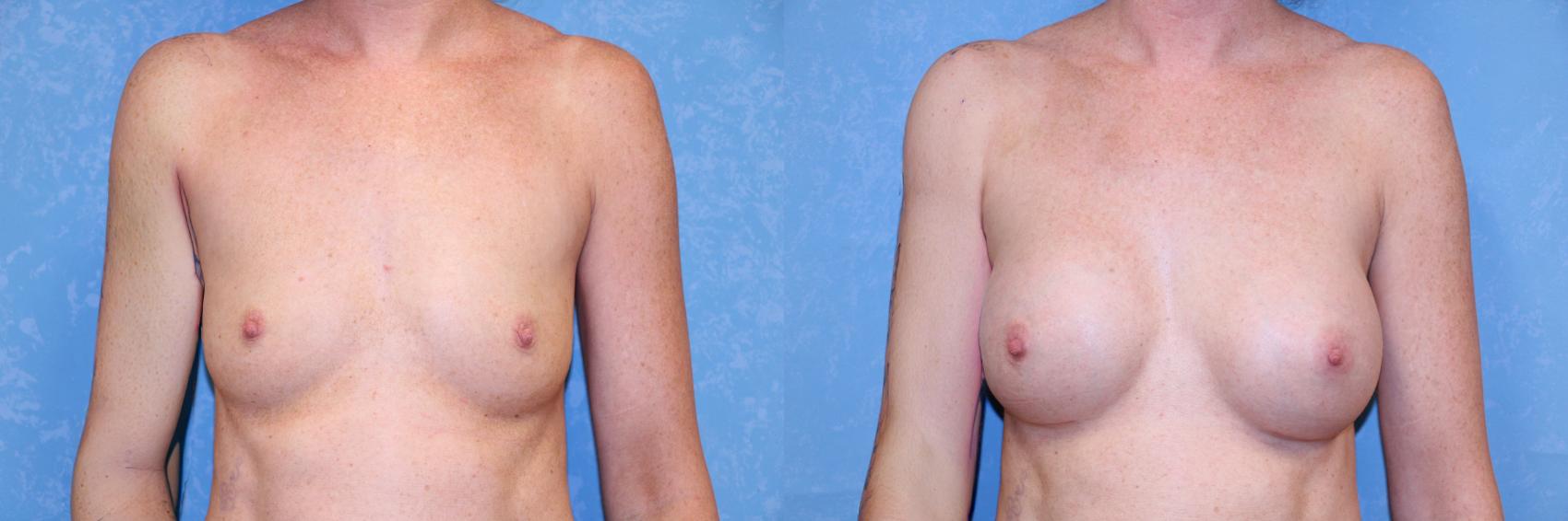 Before & After Breast Augmentation Case 610 Front View in Toledo, Ohio