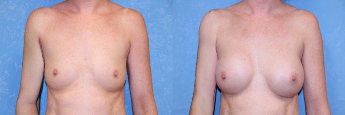 Before & After Breast Augmentation Case 610 Front View in Toledo, Ohio