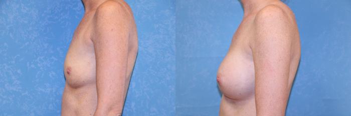 Before & After Breast Augmentation Case 610 Left Side View in Toledo, Ohio