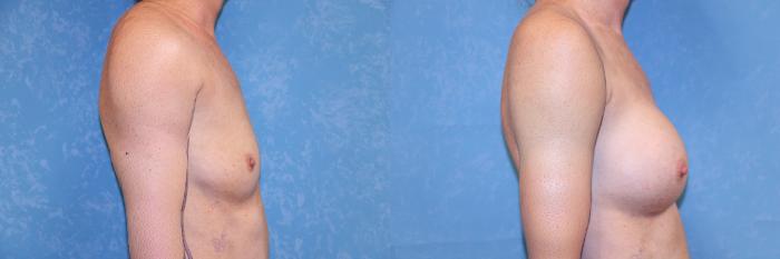 Before & After Breast Augmentation Case 610 Right Side View in Toledo, Ohio