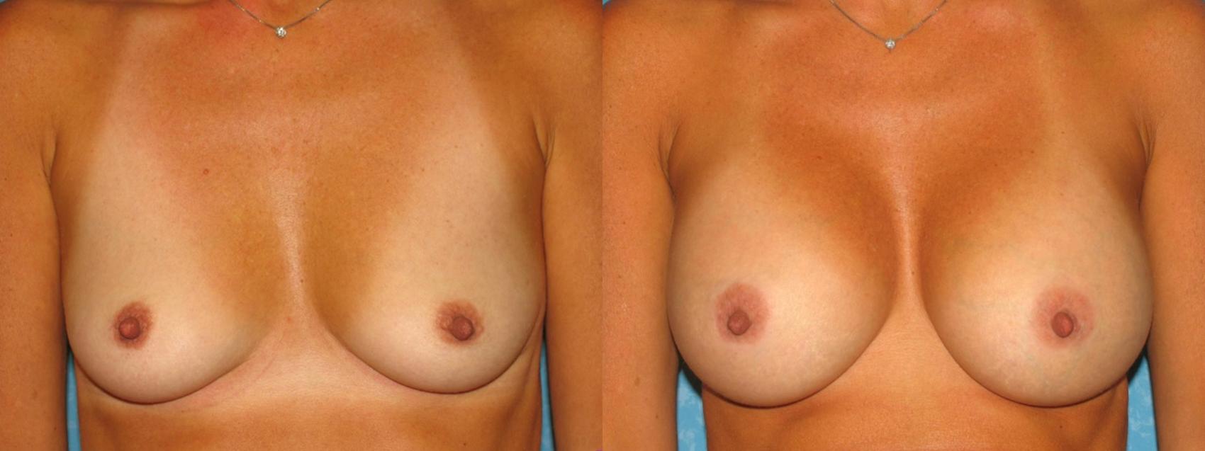 Before & After Breast Augmentation Case 64 View #1 View in Toledo, Ohio