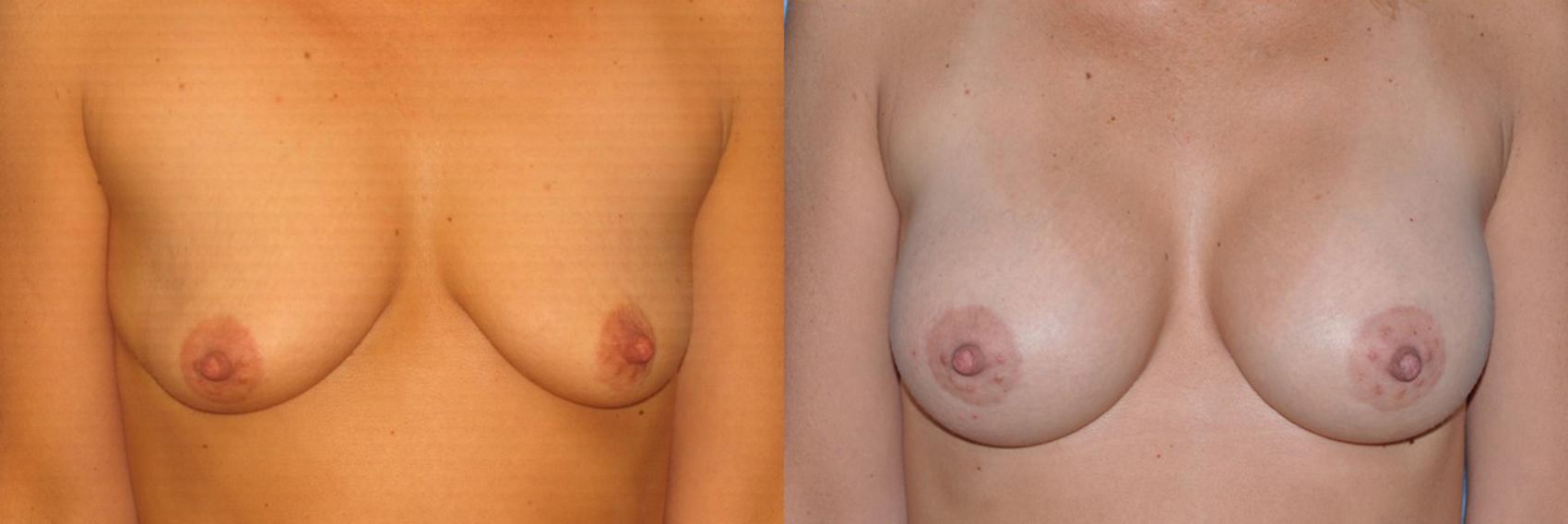 Before & After Breast Augmentation Case 65 View #1 View in Toledo, Ohio