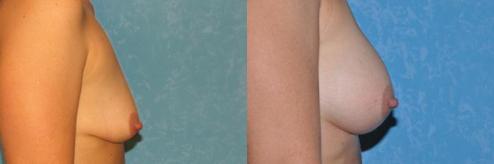 Before & After Breast Augmentation Case 65 View #2 View in Toledo, Ohio