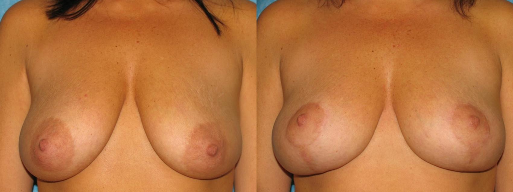 Before & After Breast Lift Case 12 View #1 View in Toledo, Ohio