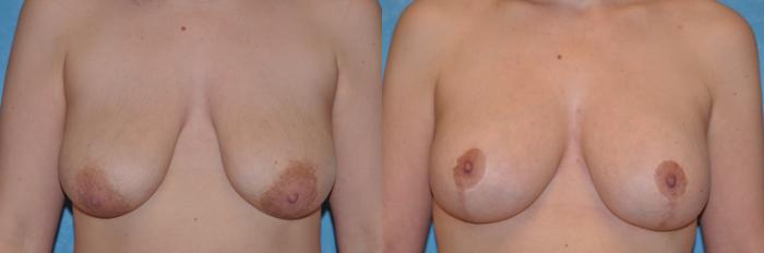 Before & After Breast Lift Case 149 View #2 View in Toledo, Ohio