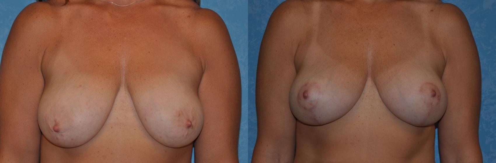 Before & After Breast Lift Case 309 View #1 View in Toledo, Ohio