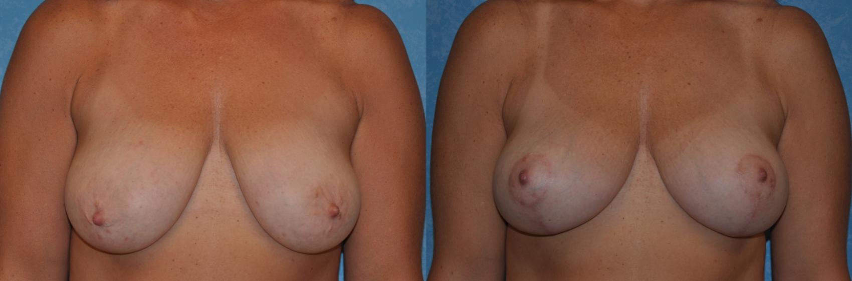 Before & After Breast Lift Case 309 View #1 View in Toledo, Ohio