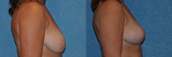 Before & After Breast Lift Case 309 View #2 View in Toledo, Ohio