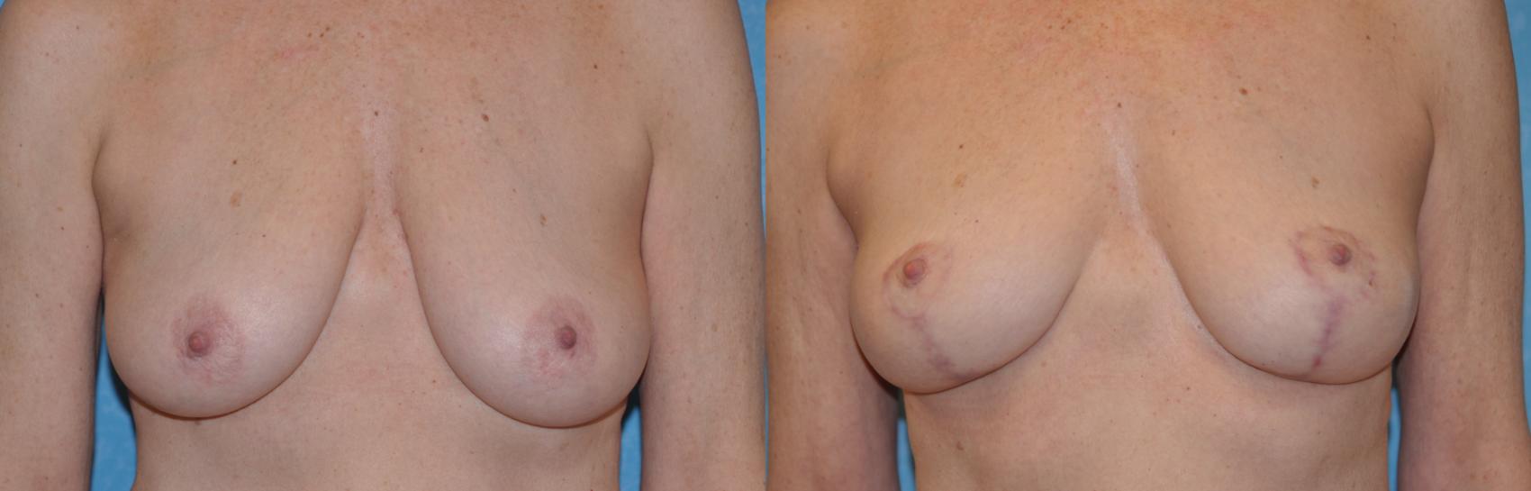 Before & After Breast Lift Case 327 View #1 View in Toledo, Ohio