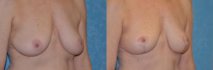 Before & After Breast Lift Case 327 View #2 View in Toledo, Ohio