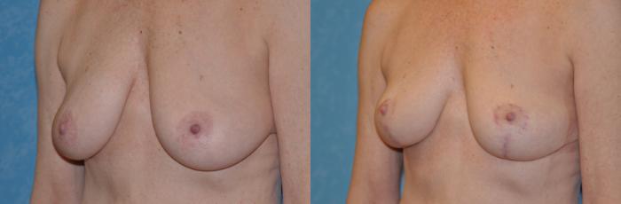 Before & After Breast Lift Case 327 View #3 View in Toledo, Ohio