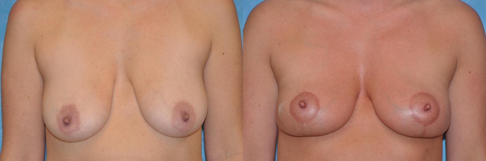 Before & After Breast Lift Case 346 View #1 View in Toledo, Ohio