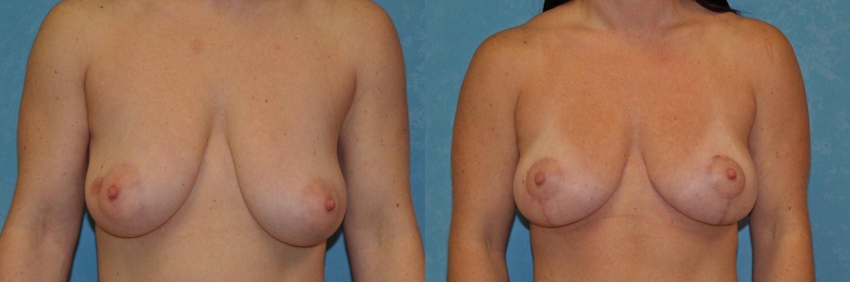 Before & After Breast Lift Case 388 Front View in Toledo, Ohio