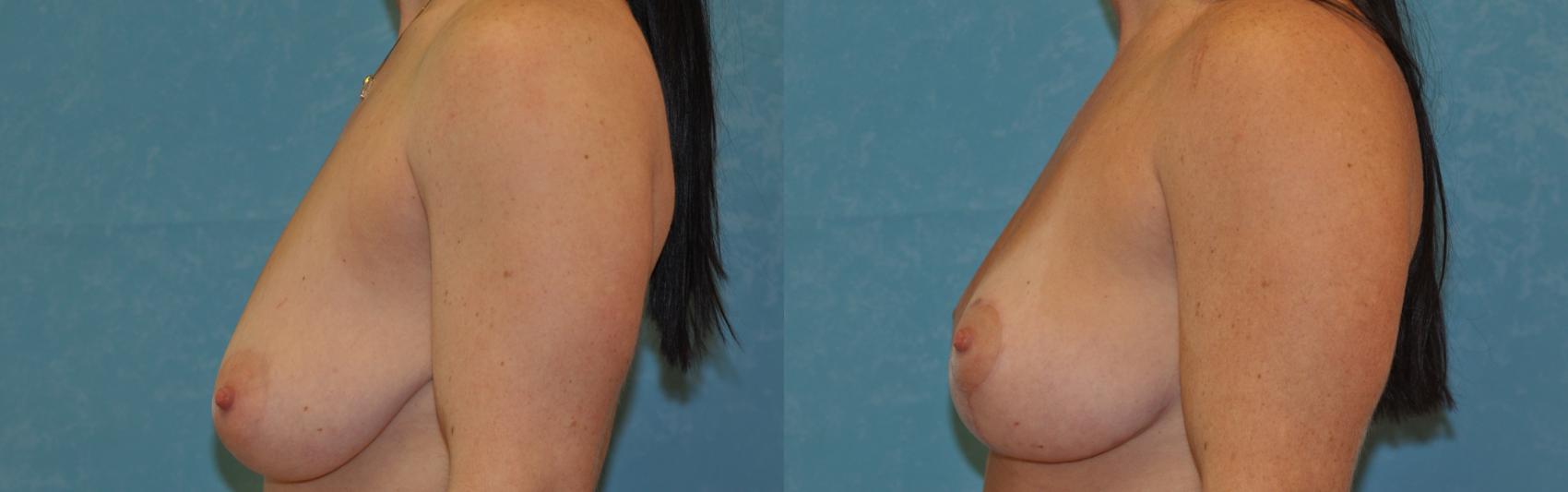 Before & After Breast Lift Case 388 Left Side View in Toledo, Ohio