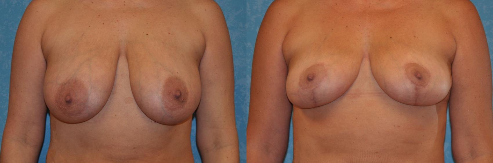 Before & After Breast Lift Case 393 Front View in Toledo, Ohio