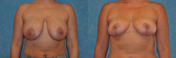 Before & After Breast Lift Case 393 Front View in Toledo, Ohio