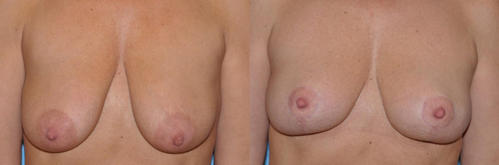 Before & After Breast Lift Case 45 View #1 View in Toledo, Ohio
