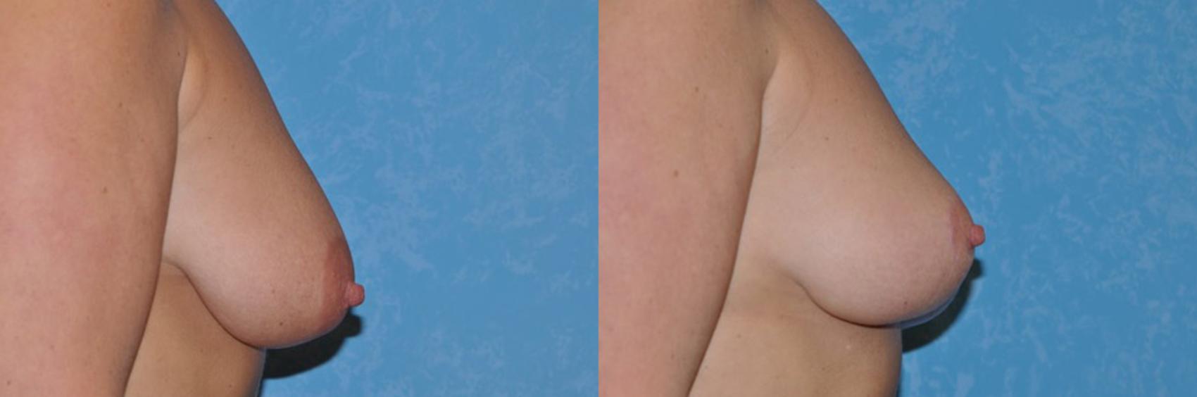 Before & After Breast Lift Case 45 View #2 View in Toledo, Ohio