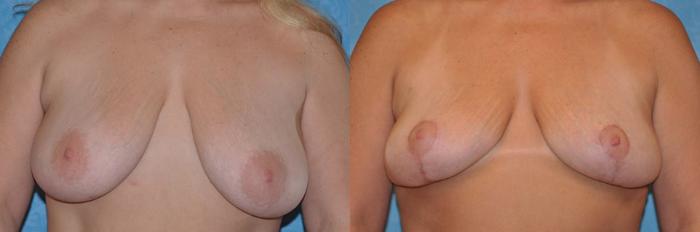 Before & After Breast Lift Case 46 View #1 View in Toledo, Ohio