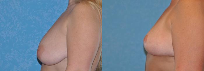Before & After Breast Lift Case 46 View #2 View in Toledo, Ohio