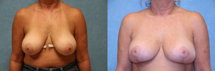 Before & After Breast Reduction Case 490 Front View in Toledo, Ohio