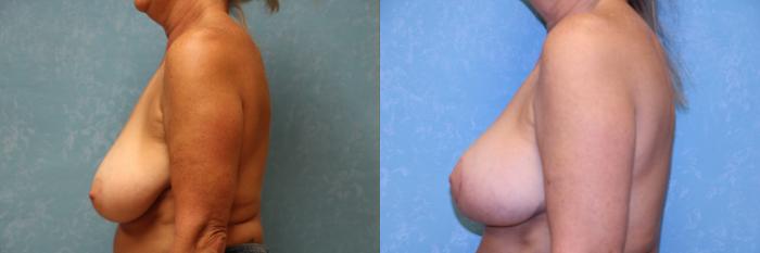 Before & After Breast Reduction Case 490 Left Side View in Toledo, Ohio
