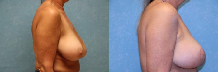 Before & After Breast Lift Case 490 Right Side View in Toledo, Ohio