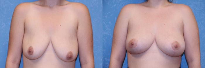 Before & After Breast Lift Case 493 Front View in Toledo, Ohio